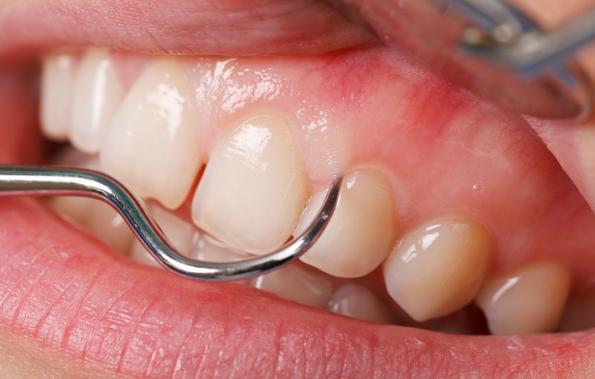 Close up of a woman's teeth and dental tool looking at gums for Connective Tissue Grafting