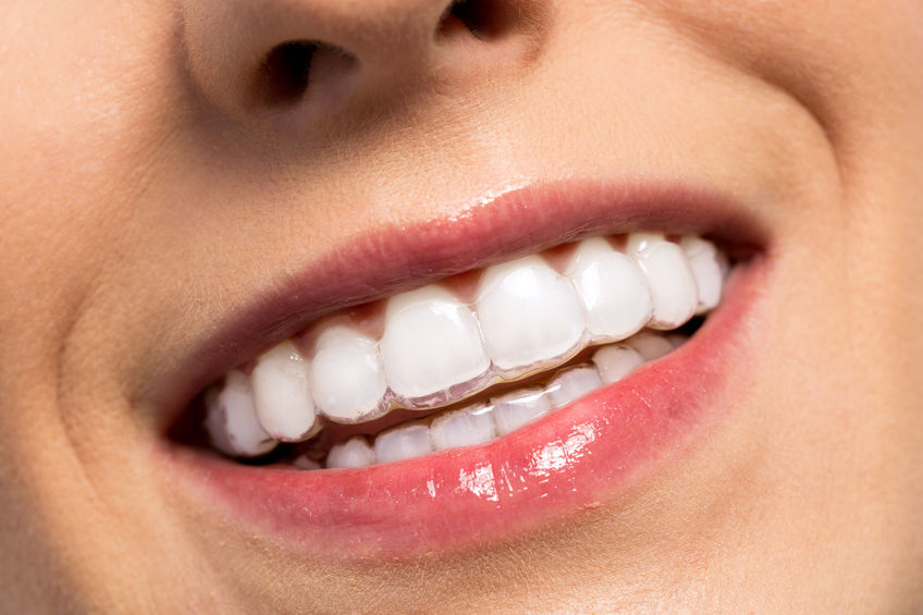 Invisalign® close up of a woman smiling with Invisalign® on.