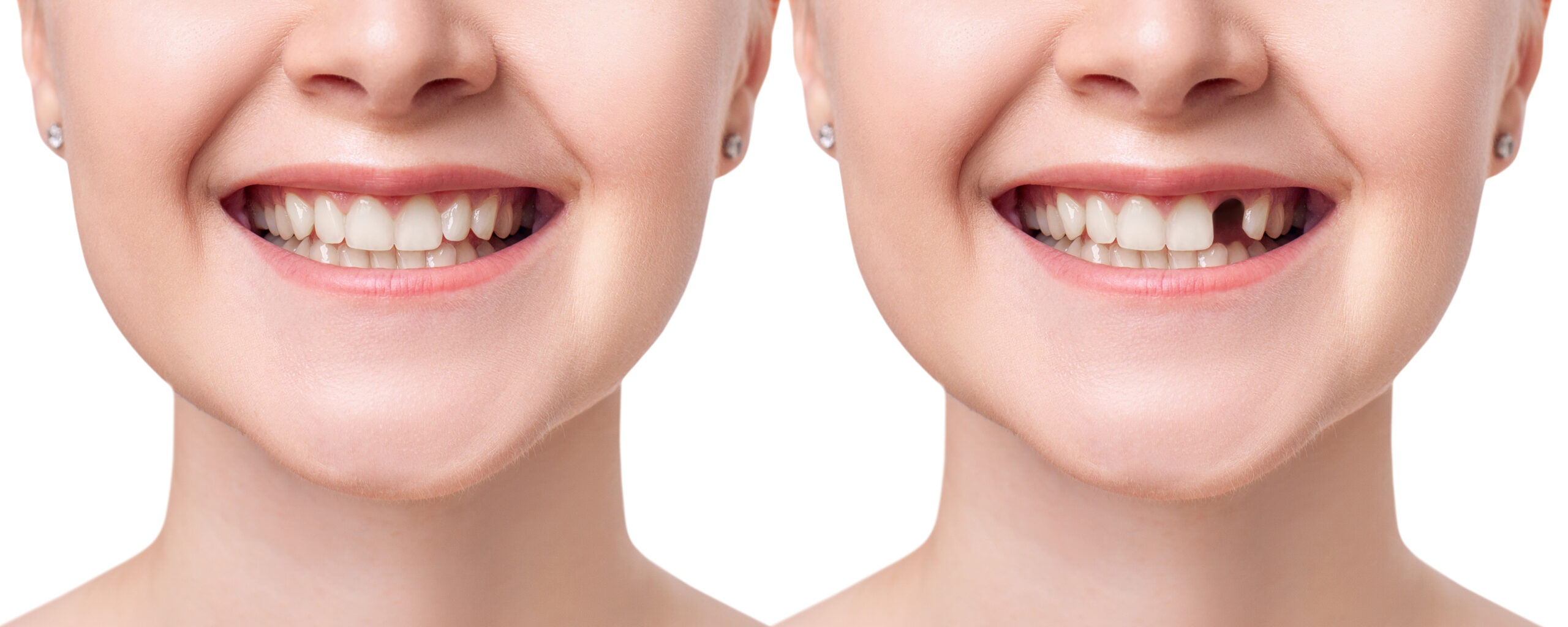 ung woman smiling before and after dental implant. Isolated on white background.